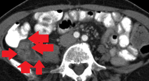 Βλεννώδες κυσταδενοκαρκίνωμα (Ευγενική παραχώρηση Dr. V. Penopoulos)