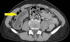CT — Βλεννοκήλη σκωληκοειδούς — Ειλεοκολική εντύλιξη (Ευγενική παραχώρηση Dr. V. Penopoulos)