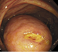 Κολονοσκοπική εικόνα εντύλιξης βλεννοκήλης σκωληκοειδούς (Ευγενική παραχώρηση Dr. V. Penopoulos)
