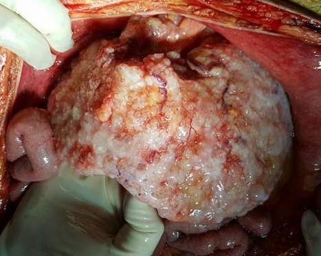 Ψευδομύξωμα περιτοναίου — Πλήρης κάλυψη μείζονος επιπλόου (Ευγενική παραχώρηση Dr. V. Penopoulos)