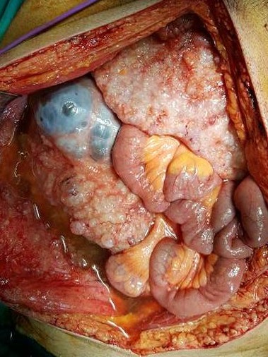 Ψευδομύξωμα περιτοναίου (Ευγενική παραχώρηση Dr. V. Penopoulos)