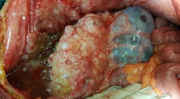 Αφαίρεση διάσπαρτου ζελατινώδους υλικού από την περιτοναϊκή κοιλότητα (Ευγενική παραχώρηση Dr. V. Penopoulos)