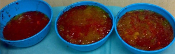 PET Scan. Αδενοκαρκίνωμα σκωληκοειδούς (Ευγενική παραχώρηση Dr. V. Penopoulos)