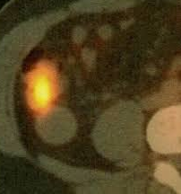 Κολονοσκοπική εικόνα βλεννοκήλης — Υποβλεννογόνια μάζα. Μπλε βέλος — «Σημείο ηφαιστείου» (Ευγενική παραχώρηση Dr. V. Penopoulos)