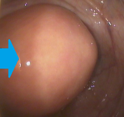 Κολονοσκοπική εικόνα βλεννοκήλης — Υποβλεννογόνια μάζα. Μπλε βέλος — «Σημείο ηφαιστείου» (Ευγενική παραχώρηση Dr. V. Penopoulos)