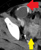 Λαπαροσκοπική άποψη βλεννοκήλης σκωληκοειδούς (Ευγενική παραχώρηση Dr. V. Penopoulos)
