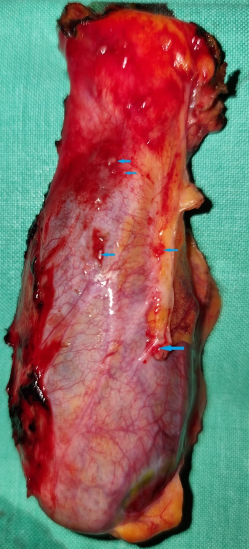 Παρασκεύασμα μείζονος επιπλόου. Παρουσία πολλαπλών μικροσκοπικών εμφυτευμάτων (Ευγενική παραχώρηση Dr. V. Penopoulos)