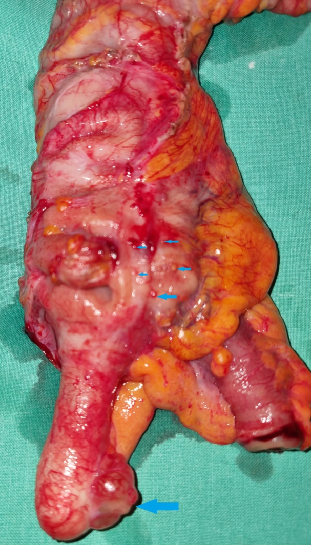 Βλεννοζελατινώδες περιεχόμενο βλεννοκήλης σκωληκοειδούς (Ευγενική παραχώρηση Dr. V. Penopoulos)