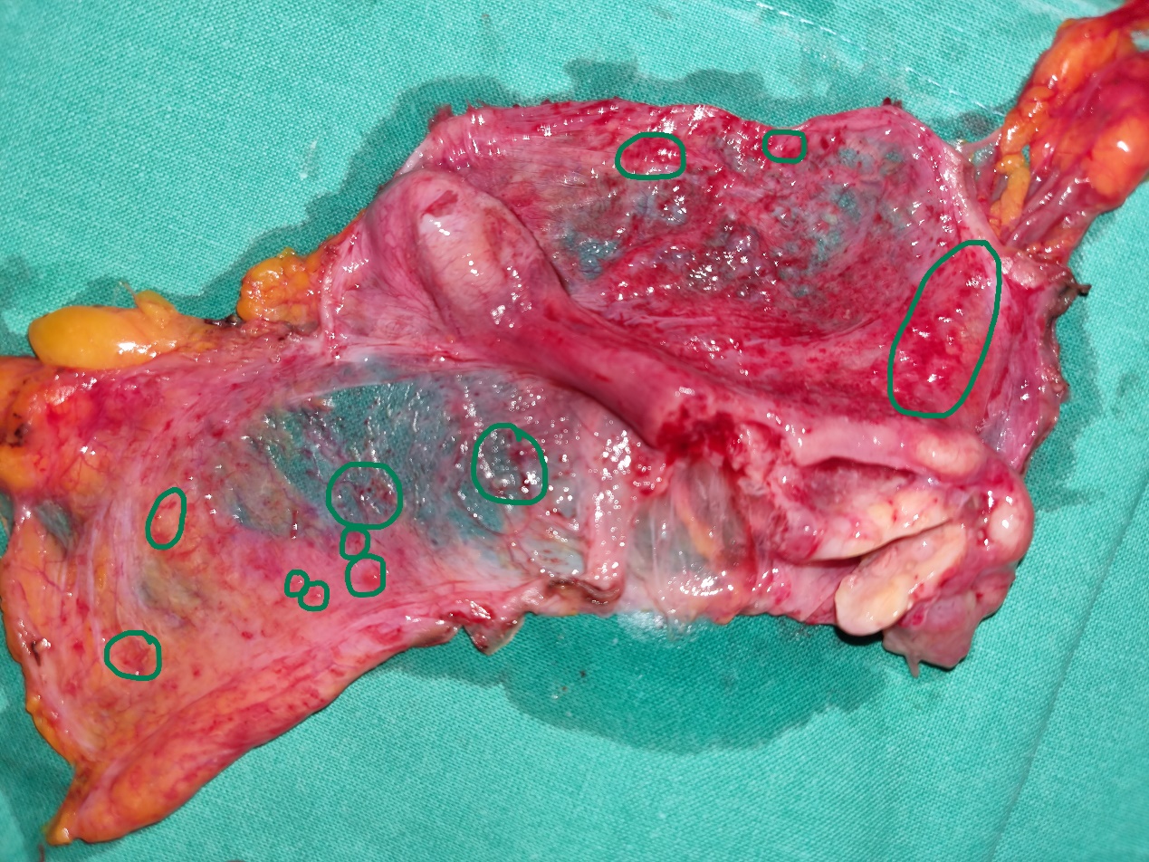 Ιστοπαθολογική εξέταση βλεννοκήλης σκωληκοειδούς. Εκτεταμένη βλέννα στον αυλό της σκωληκοειδούς, ατροφία βλεννογόνου, λέπτυνση τοιχώματος και χρόνια φλεγμονώδης κυτταρική διήθηση (Ευγενική παραχώρηση Dr. V. Penopoulos)