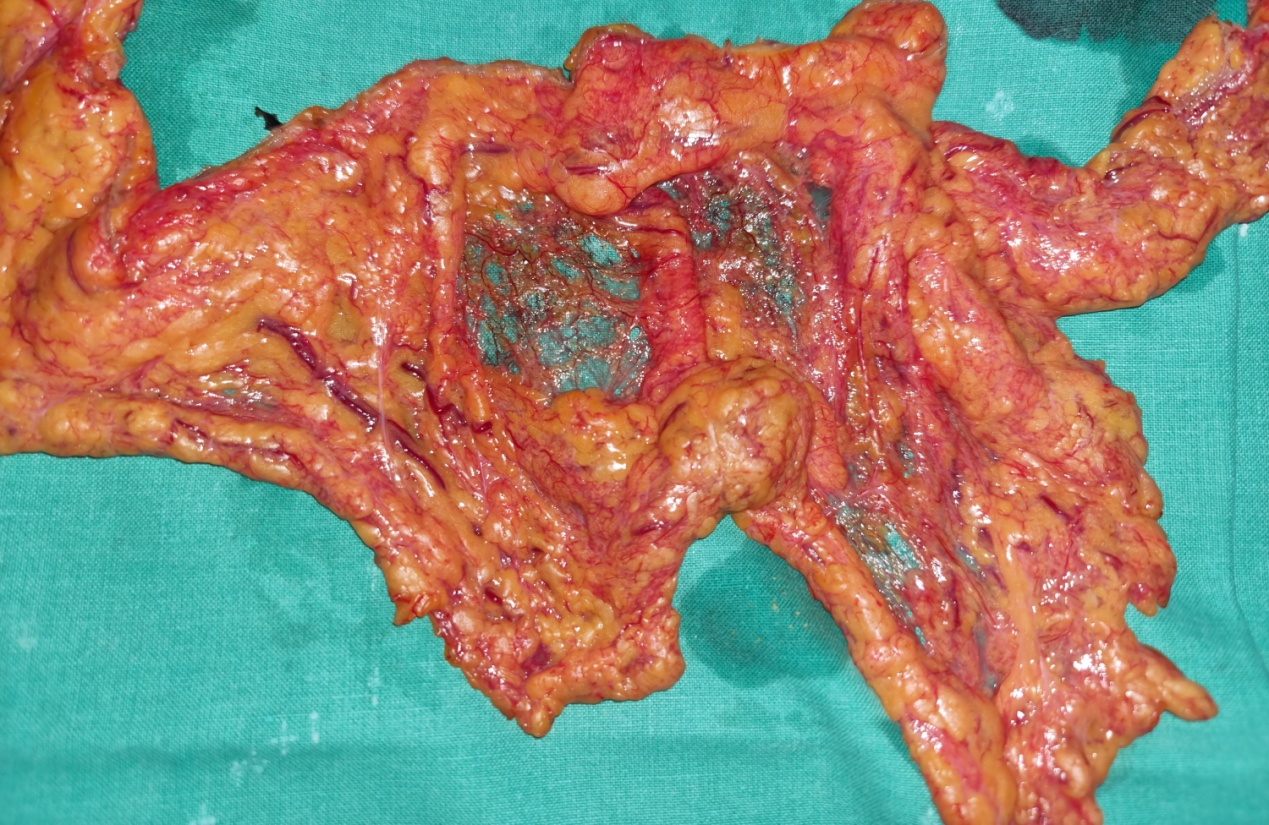 Ιστοπαθολογική εξέταση βλεννοκήλης σκωληκοειδούς. Εκτεταμένη βλέννα στον αυλό της σκωληκοειδούς, ατροφία βλεννογόνου, λέπτυνση τοιχώματος και χρόνια φλεγμονώδης κυτταρική διήθηση (Ευγενική παραχώρηση Dr. V. Penopoulos)