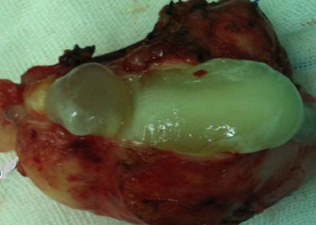 Κατακρατητική βλεννοκήλη (Ευγενική παραχώρηση Dr. V. Penopoulos)