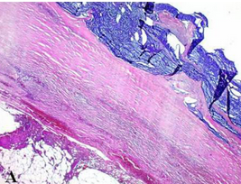 Κατακρατητική βλεννοκήλη (Ευγενική παραχώρηση Dr. V. Penopoulos)