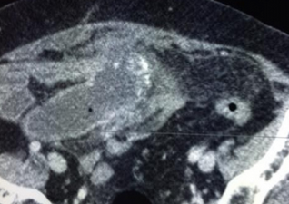 Κατακρατητική βλεννοκήλη (Ευγενική παραχώρηση Dr. V. Penopoulos)