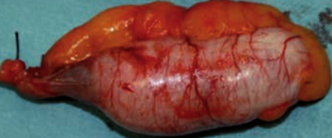 Κατακρατητική βλεννοκήλη (Ευγενική παραχώρηση Dr. V. Penopoulos)