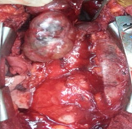 Ιστοπαθολογική εξέταση — Πολυοζώδης βρογχοκήλη (Ευγενική παραχώρηση Dr. V. Penopoulos)