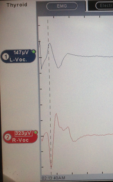 Ιστοπαθολογική εξέταση — Πολυοζώδης βρογχοκήλη (Ευγενική παραχώρηση Dr. V. Penopoulos)