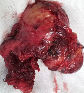 Ιστοπαθολογική εξέταση — Πολυοζώδης βρογχοκήλη (Ευγενική παραχώρηση Dr. V. Penopoulos)