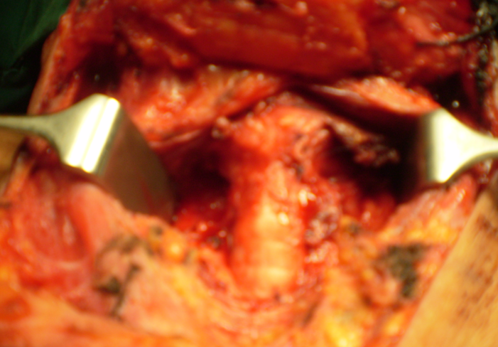 Ιστοπαθολογική εξέταση — Πολυοζώδης βρογχοκήλη (Ευγενική παραχώρηση Dr. V. Penopoulos)