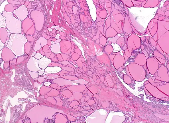 Ιστοπαθολογική εξέταση — Πολυοζώδης βρογχοκήλη (Ευγενική παραχώρηση Dr. V. Penopoulos)