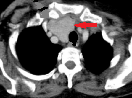 CT θώρακος-τραχήλου. Κόκκινα βέλη — Πολύ μεγάλη οπισθοστερνική βρογχοκήλη. Κίτρινα βέλη — Κλείδες (Ευγενική παραχώρηση Dr. V. Penopoulos)