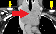 Σπινθηρογράφημα θυρεοειδούς. Είναι εμφανής η οπισθοστερνική θέση, χωρίς θερμές ή ψυχρές περιοχές (Ευγενική παραχώρηση Dr. V. Penopoulos)