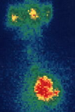 Αυχενική τομή κατά Kocher (Ευγενική παραχώρηση Dr. V. Penopoulos)