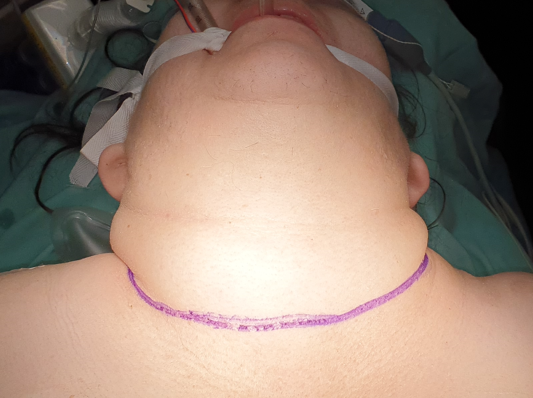 Τμήμα δεξιού λοβού θυρεοειδούς (Ευγενική παραχώρηση Dr. V. Penopoulos)