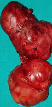 Αρτηρία θυρεοειδούς Neubauer. Thyroidea ima αρτηρία (Ευγενική παραχώρηση Dr. V. Penopoulos)