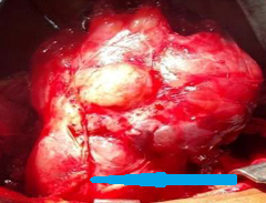 Χειρουργικό πεδίο μετά από στερνοτομία (Ευγενική παραχώρηση Dr. V. Penopoulos)