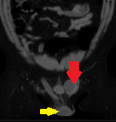 Κόκκινο βέλος — Εκτοπισμένος όρχις στην αριστερή βουβωνική χώρα. Κίτρινο βέλος — Δεξιός όρχις εντός οσχέου (Ευγενική παραχώρηση Dr. V. Penopoulos)