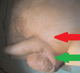 Κόκκινο βέλος — Εκτοπισμένος όρχις στην αριστερή βουβωνική χώρα. Κίτρινο βέλος — Δεξιός όρχις εντός οσχέου (Ευγενική παραχώρηση Dr. V. Penopoulos)