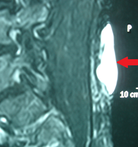 MRI οσφύος — Η βλάβη εμφανώς περιορίζεται στο δέρμα και τον υποδόριο ιστό (Ευγενική παραχώρηση Dr. V. Penopoulos)