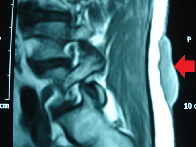 MRI οσφύος — Η βλάβη εμφανώς περιορίζεται στο δέρμα και τον υποδόριο ιστό (Ευγενική παραχώρηση Dr. V. Penopoulos)