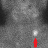 Εκτομή αδενώματος (Ευγενική παραχώρηση Dr. V. Penopoulos)