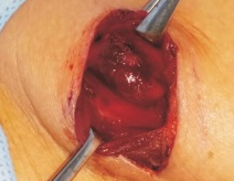 Εκτομή αδενώματος (Ευγενική παραχώρηση Dr. V. Penopoulos)