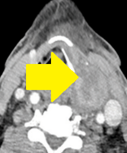 CT — Well-circumscribed nodule in contact with the lower pole of the left thyroid lobe (Courtesy Dr. V. Penopoulos)