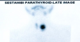 99mTc Sestamibi scintigraphy — Increased uptake of left inferior parathyroid gland (Courtesy Dr. V. Penopoulos)