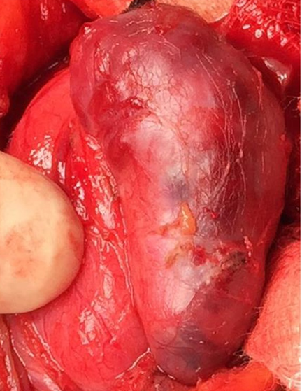 Intraoperative view of giant adenoma before excision (Courtesy Dr. V. Penopoulos)