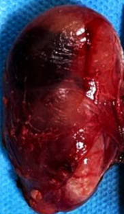 Adenoma surgical specimen (Courtesy Dr. V. Penopoulos)