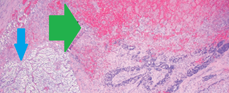 Blue arrow — Parathyroid adenoma. Green arrow — Area of necrosis and hemorrhage (Courtesy Dr. V. Penopoulos)