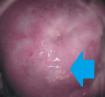 Blue arrow — Sebaceous glands of the exocervix (Courtesy Dr. V. Penopoulos)