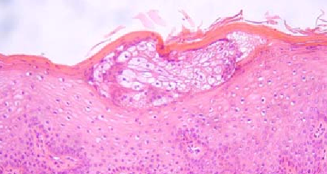 Sebaceous glands of the exocervix (Courtesy Dr. V. Penopoulos)