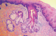Sebaceous glands of the exocervix (Courtesy Dr. V. Penopoulos)