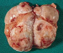 Παρασκεύασμα δεξιάς ορχεκτομής. Ευγενική παραχώρηση Dr. V. Penopoulos.