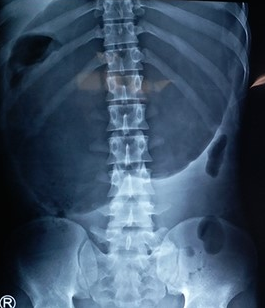 Plain abdominal radiograph – Gastric volvulus. Courtesy Dr. V. Penopoulos.