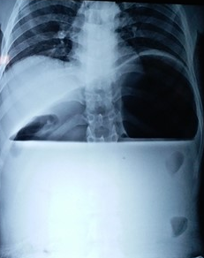 Abdominal computed tomography – Gastric volvulus. Courtesy Dr. V. Penopoulos.