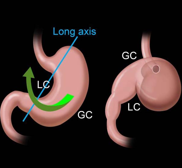 Lower sections of abdominal computed tomography – Red arrow: Wandering spleen torsion. Courtesy Dr. V. Penopoulos.