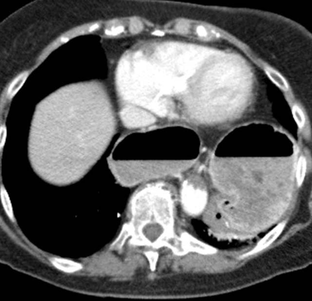 Red arrow – Wandering spleen. Pink arrow – Gastric volvulus. Brown arrow – Liver. Courtesy Dr. V. Penopoulos.