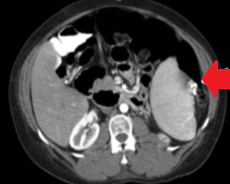 Exploratory laparotomy – Splenic torsion. Courtesy Dr. V. Penopoulos.