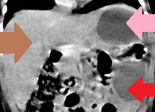 Green arrow – Splenic pedicle. Red arrow – Spleen fixed in retroperitoneal position. Courtesy Dr. V. Penopoulos.
